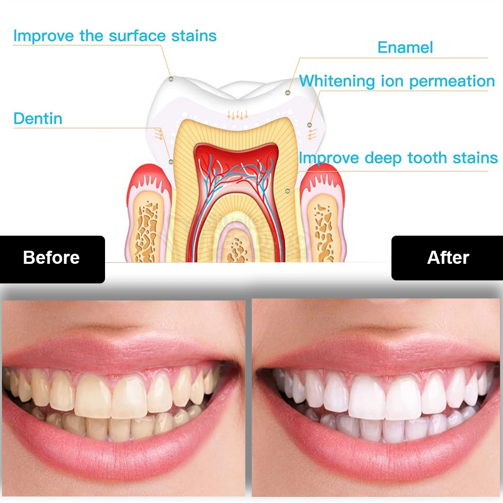 歯科歯ホワイトニングキットミニ 16 LED コールドライト - Teeth Whitening Results のレビューと価格